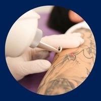 Remoção de Tatuagem
