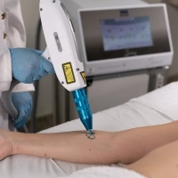 Remoção de Tatuagem