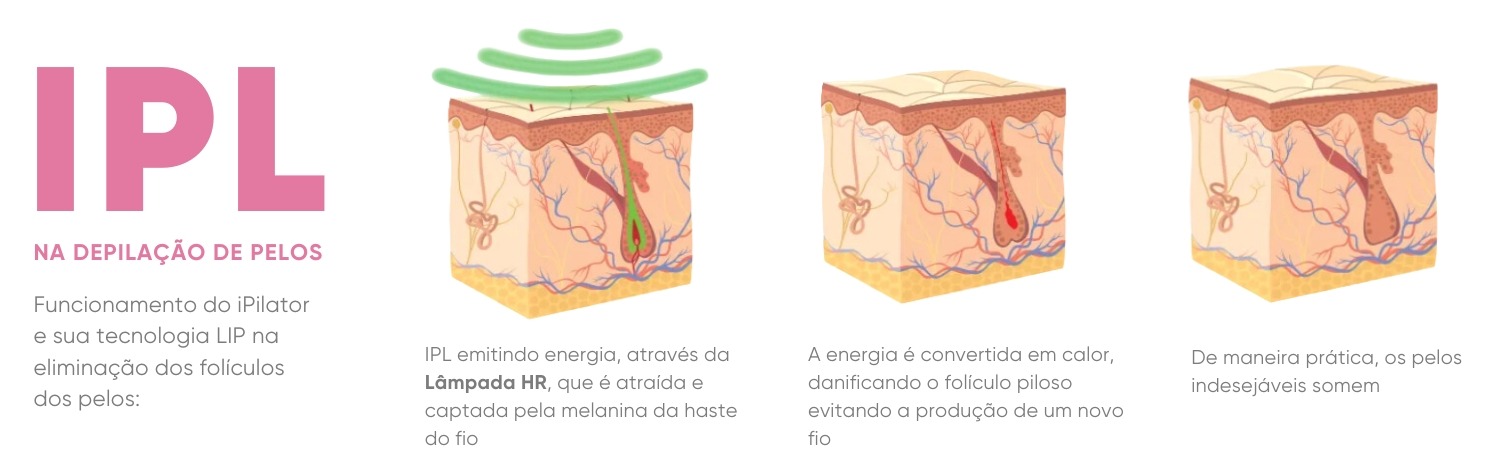 funcionamento ipilator ii