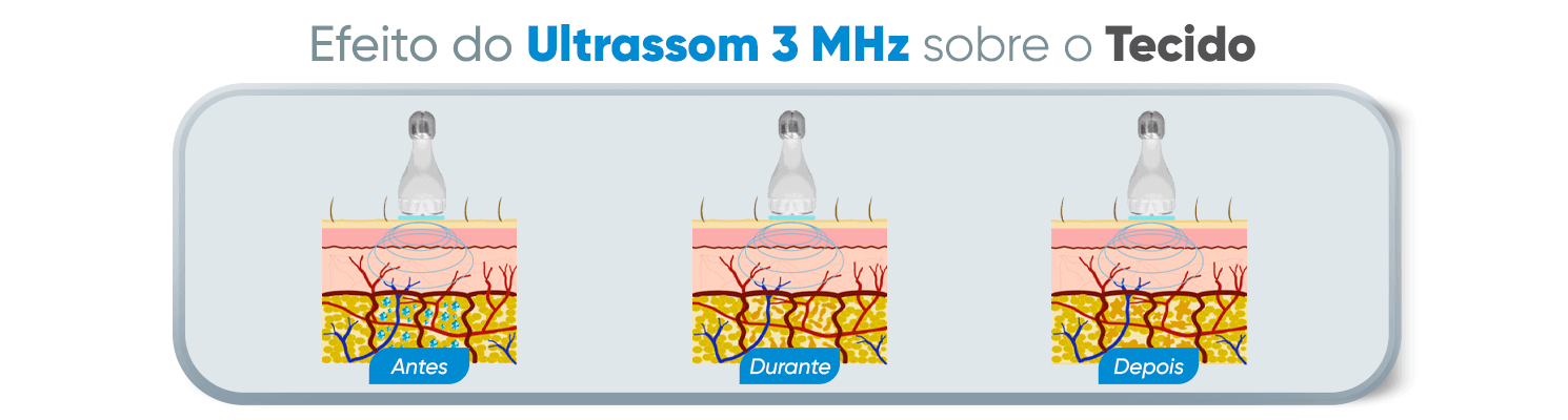 efeitos do ultrassom 3mhz