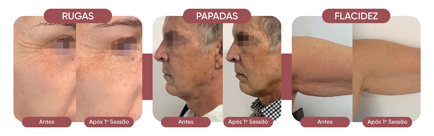 hipro ultrassom contourline - antes e depois