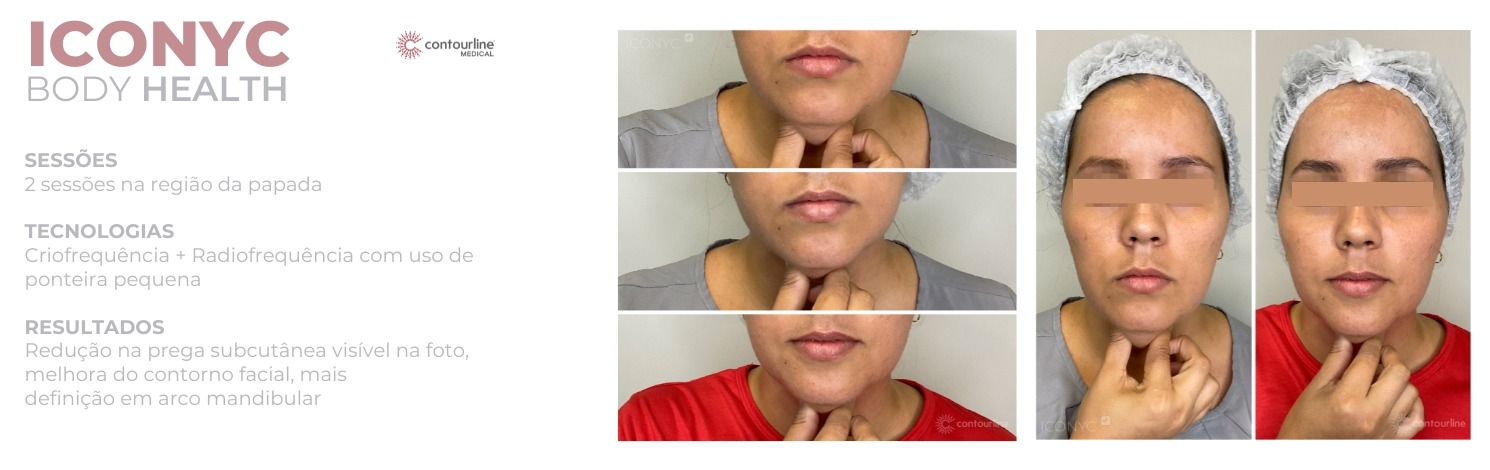 resultados facias - Antes e Depois com Body Health - facial