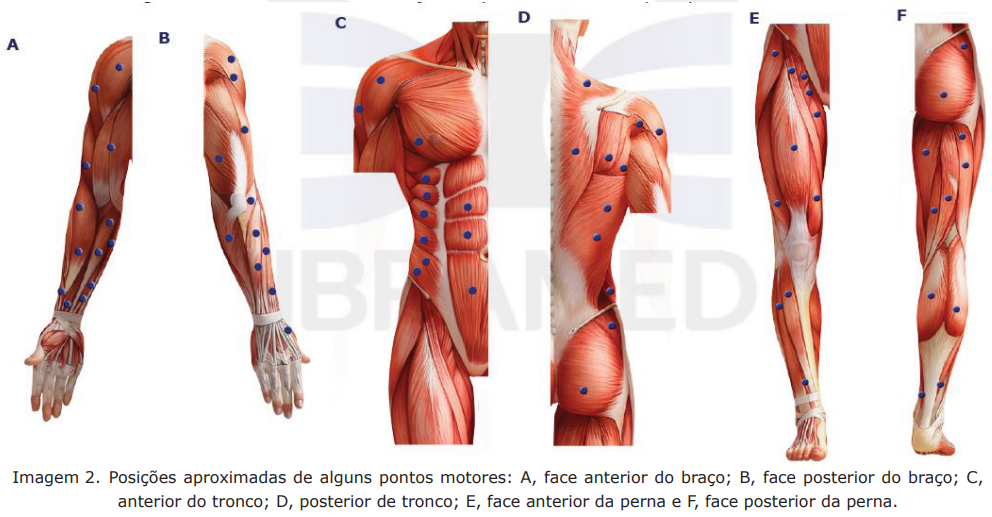 Foto ilustrativa para indicação de pontos em que usar o estimulador muscular