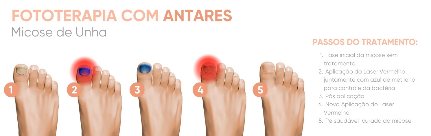 podologia antares da ibramed