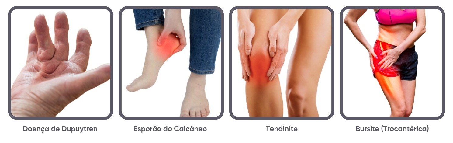 reabilitação Thork - Aparelho de Ondas de Choque