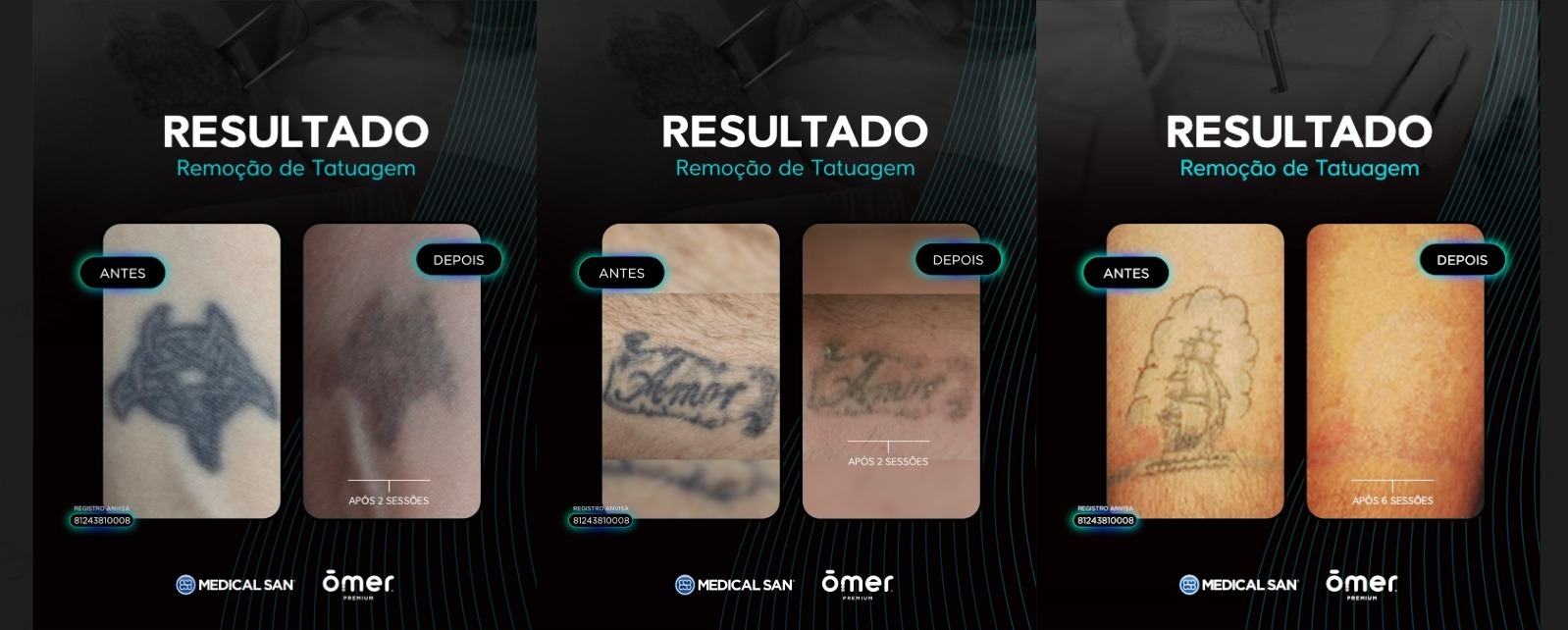 Comparação de antes de depois do laser para remoção de tatuagens Ômer Premium