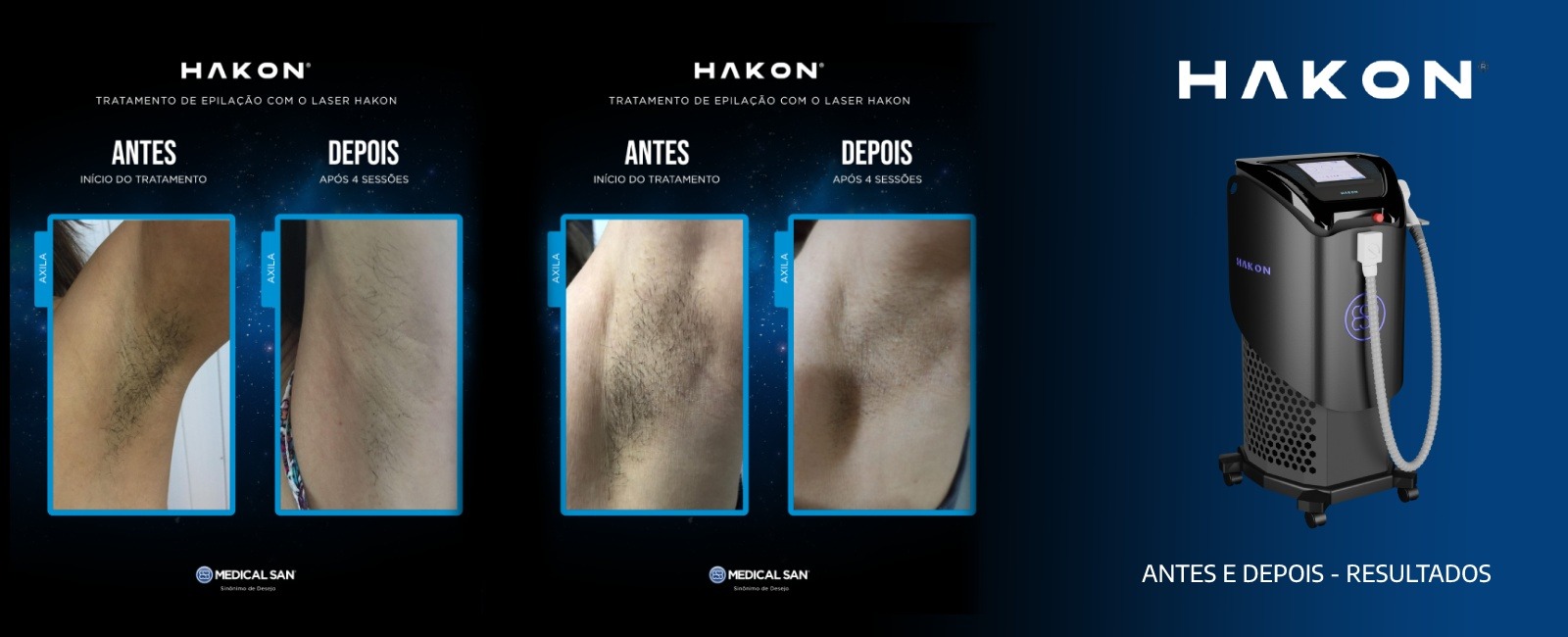 Comparação do antes e depois da eficácia do equipamento Hakon laser 4D