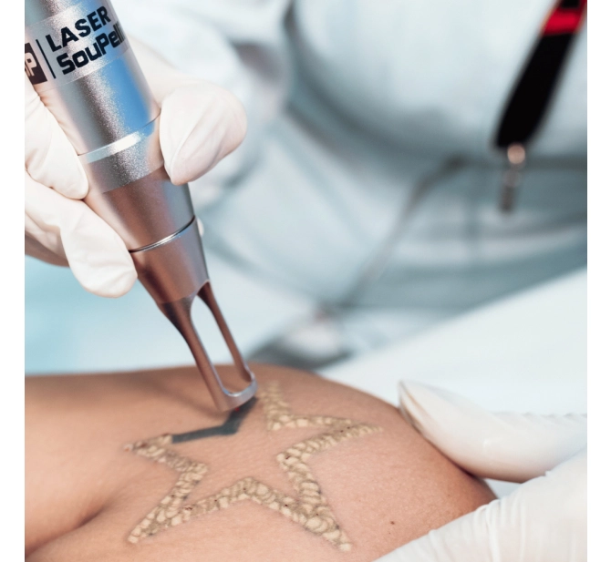 Beta Laser Premium - Laser de Picossegundo - SouPelli