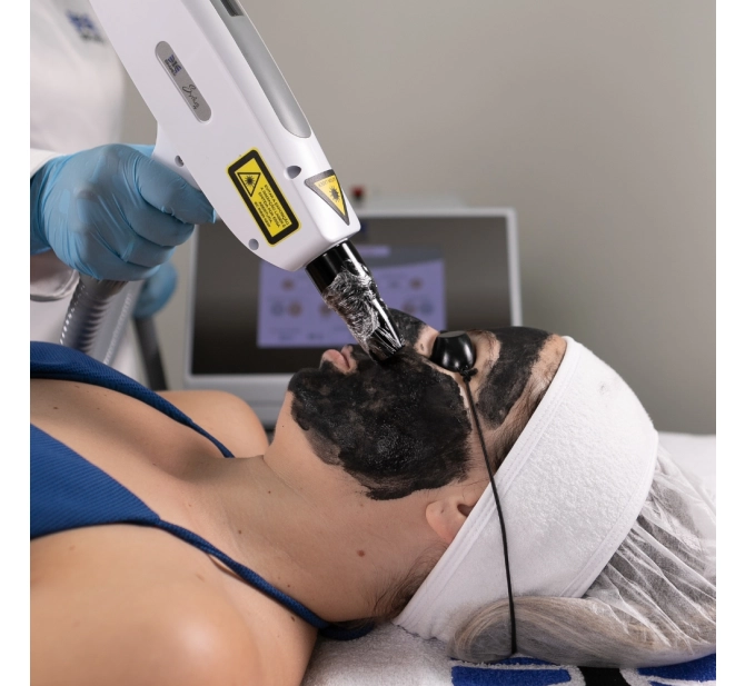 Syrius Yag - Laser para Remoção de Tatuagem e Black Peel - Ibramed