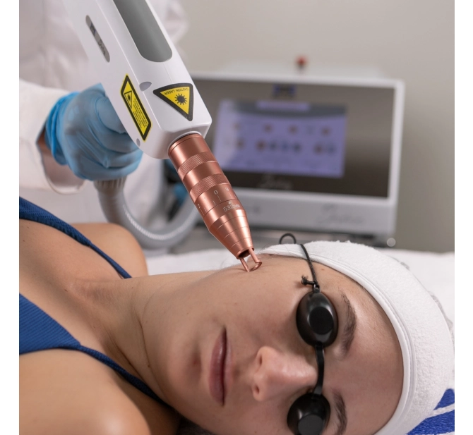 Syrius Yag - Laser para Remoção de Tatuagem e Black Peel - Ibramed