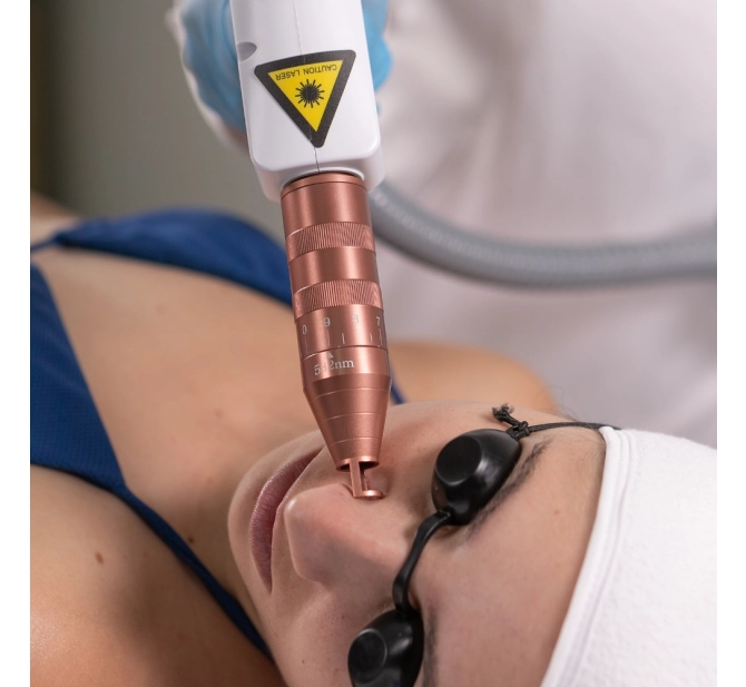 Syrius Yag - Laser para Remoção de Tatuagem e Black Peel - Ibramed