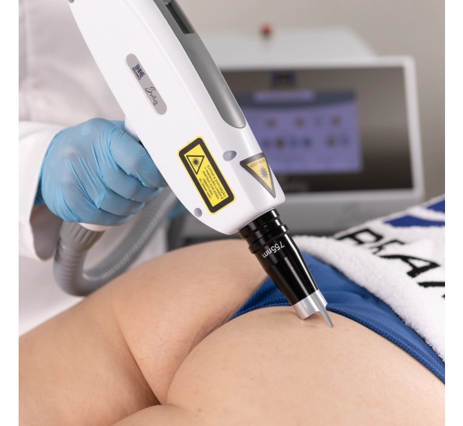 Syrius Yag - Laser para Remoção de Tatuagem e Black Peel - Ibramed