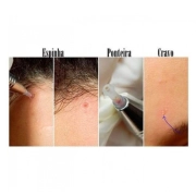 Caneta Extratora De Cravos E Espinhas - Face Clean