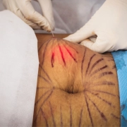 Dual Lift - Aparelho de Endolaser 980nm a 1470nm - SouPelli