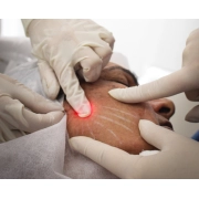 Dual Lift - Aparelho de Endolaser 980nm a 1470nm - SouPelli