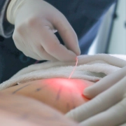 LiftEndo Endolaser de Alta Potência Dual Wave 1470nm e 980nm - Medical San