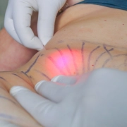 LiftEndo Endolaser de Alta Potência Dual Wave 1470nm e 980nm - Medical San