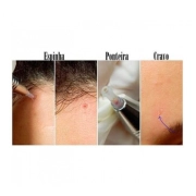 Ponteiras Descartáveis Para Caneta Extratora De Cravos C/ 50 Un - Face Clean