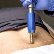 Smart Press GR - Caneta Pressurizada Para Mesoterapia e Intradermoterapia - Smart GR